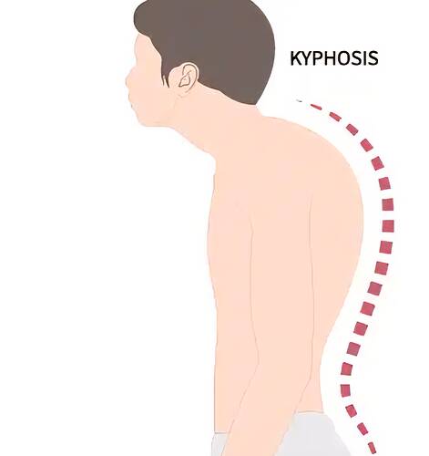 Kyphosis